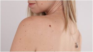 Skin Tags Removal Leeds