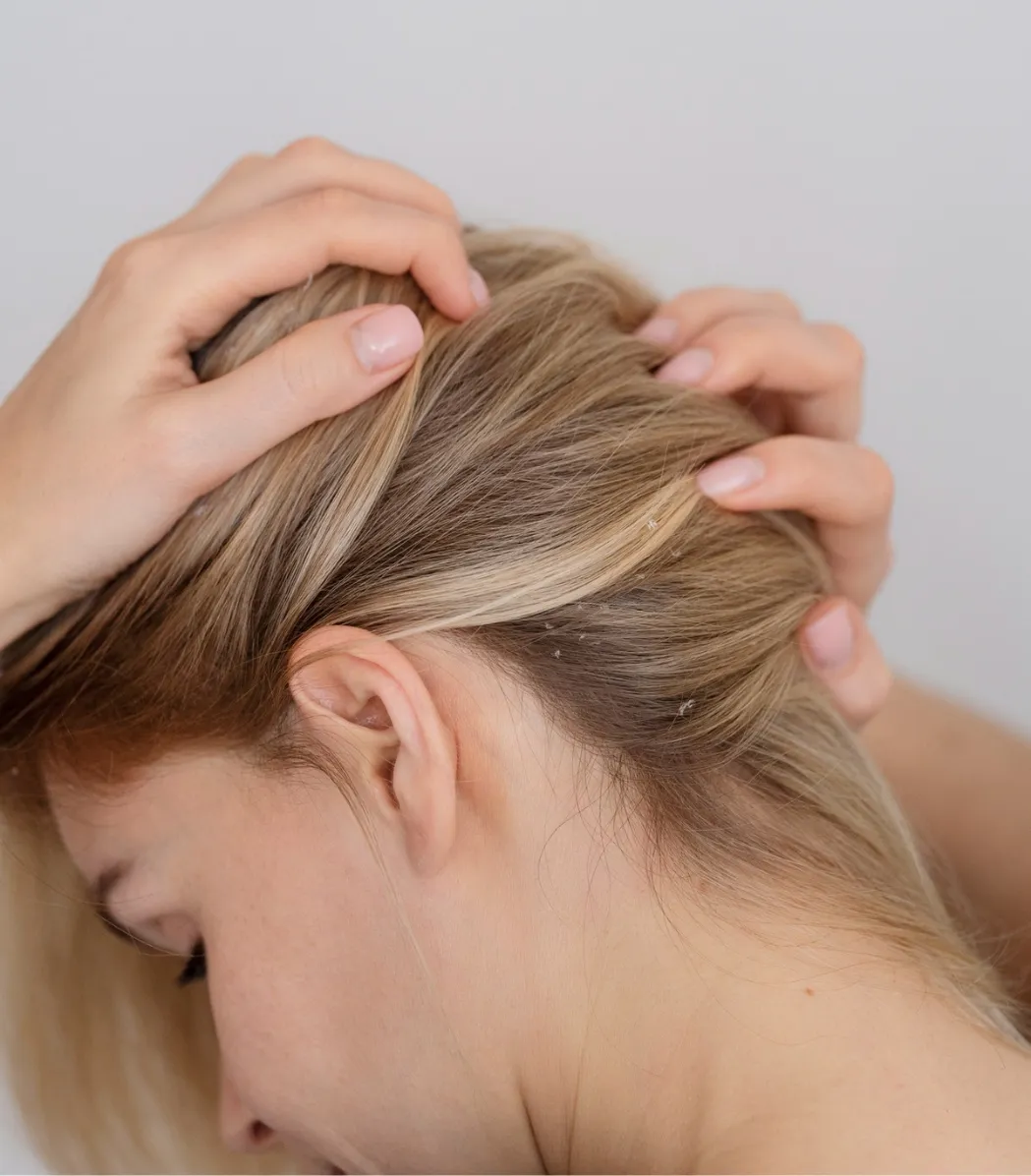 Dandruff Treatment Calicut | Charmam Skin Clinic Kozhikode