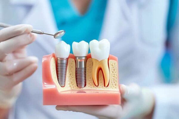 dental implants fontana