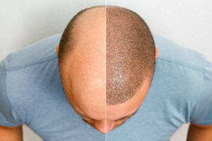 hair transplant in dammam